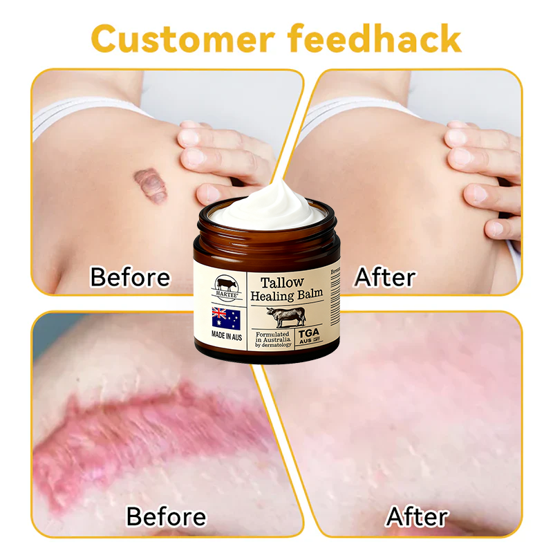 HARTEE® Tallow Healing Balm🐄（GMP Facility • TGA-Registered • Dermatologist Tested👨‍⚕️）Soothe eczema, psoriasis & rosacea—without steroids.🐄