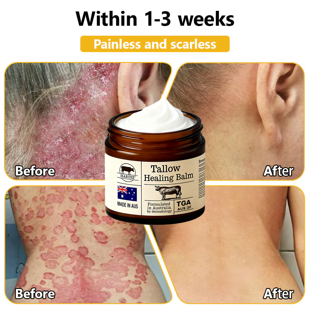 HARTEE® Tallow Healing Balm🐄（GMP Facility • TGA-Registered • Dermatologist Tested👨‍⚕️）Soothe eczema, psoriasis & rosacea—without steroids.🐄