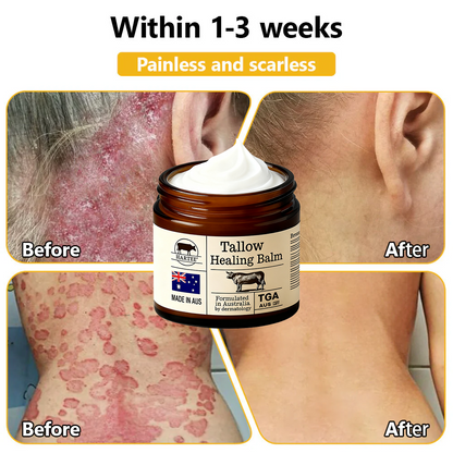 HARTEE® Tallow Healing Balm🐄（GMP Facility • TGA-Registered • Dermatologist Tested👨‍⚕️）Soothe eczema, psoriasis & rosacea—without steroids.🐄