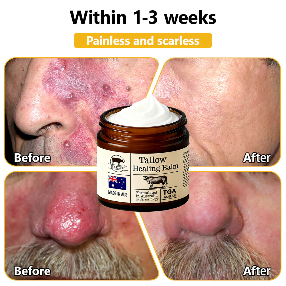 HARTEE® Tallow Healing Balm🐄（GMP Facility • TGA-Registered • Dermatologist Tested👨‍⚕️）Soothe eczema, psoriasis & rosacea—without steroids.🐄