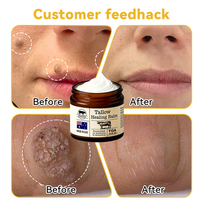 HARTEE® Tallow Healing Balm🐄（GMP Facility • TGA-Registered • Dermatologist Tested👨‍⚕️）Soothe eczema, psoriasis & rosacea—without steroids.🐄